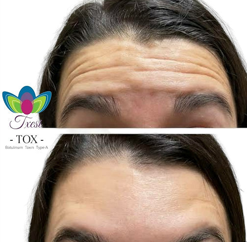 Toxina Botulínica Tipo A 100u