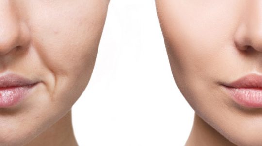 Neuramis DEEP Ácido Hialurónico Reticulado 1.1 ml