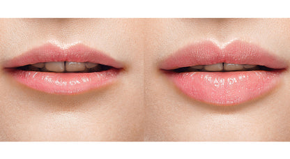 Ácido Hialurónico Reticulado FINE-LIDO 3 Piezas de 1.1 ml